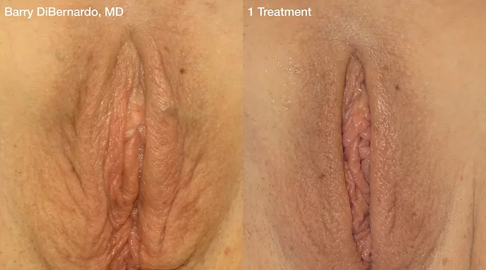 Before and After treatment