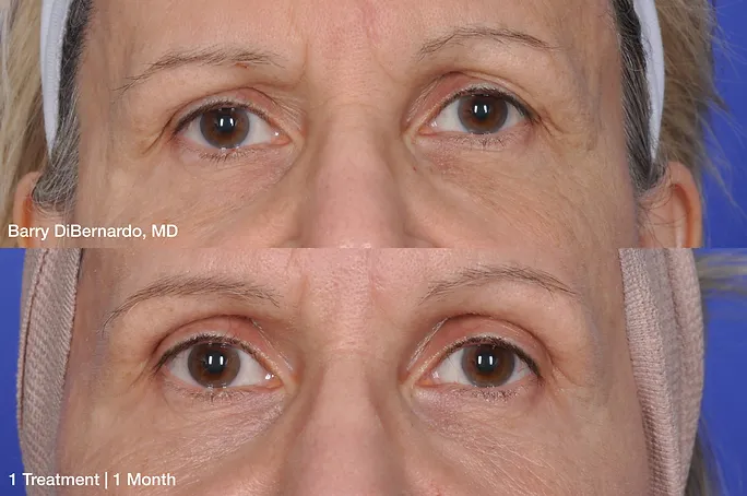 Before and After treatment